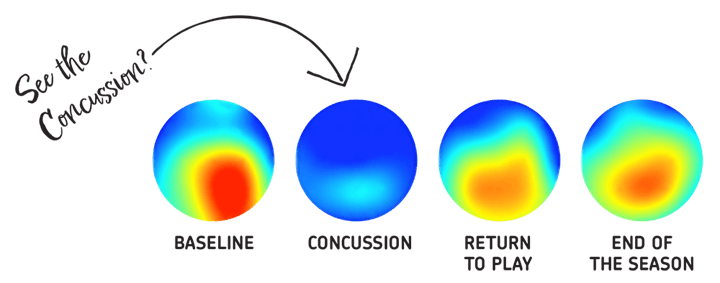 concussion-720x283